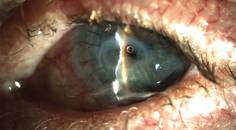 Neurotrophic Keratopathy A Practical Approach to Diagnosis and Management