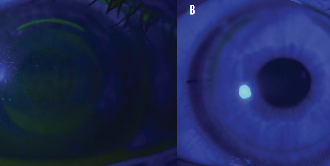 The Pros and Cons of LASIK vs SMILE