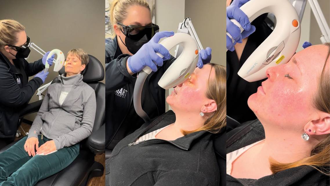 Dos and Donts of IPL Therapy