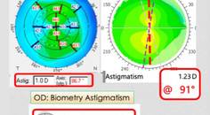 Collaborative Case 010 Managing the Unhappy Presbyopic IOL Patient