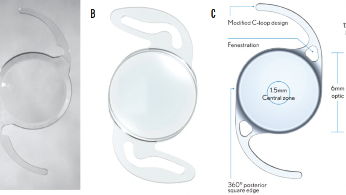Innovations in IOL Technology