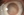 Figure 1. Note the cloudy, brownsish opacity in this patient who presented with a nuclear sclerotic cataract. Image courtesy of Justin Schweitzer, OD, FAAO