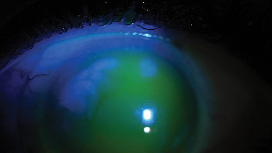 Treating Ocular Surface Disease With Scleral Lenses