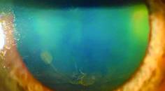 The Expanding Differential of Corneal Verticillata