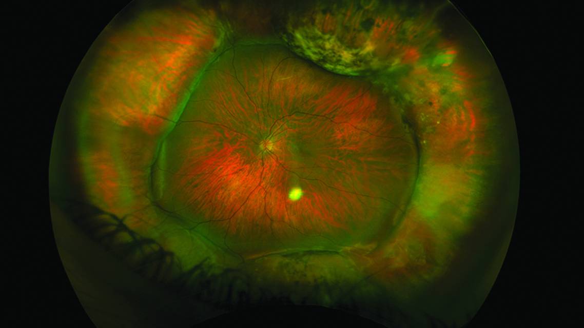Myopic Refraction With Scleral Buckle