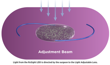 RxSight Announces Commercial Launch of the LAL+ and Features Multiple Doctor Presentations at ASCRS image