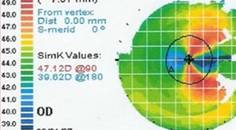Collaborative Case 012 Best Management of a Visually Significant Cataract and a Nasal Pterygium
