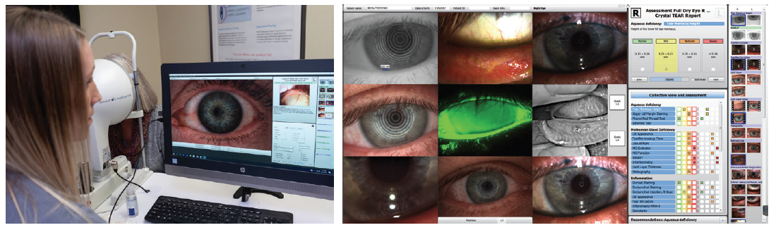 Dry Eye Story Maximizing Workflow Implementing Advanced Technologies Finding Fulfillment