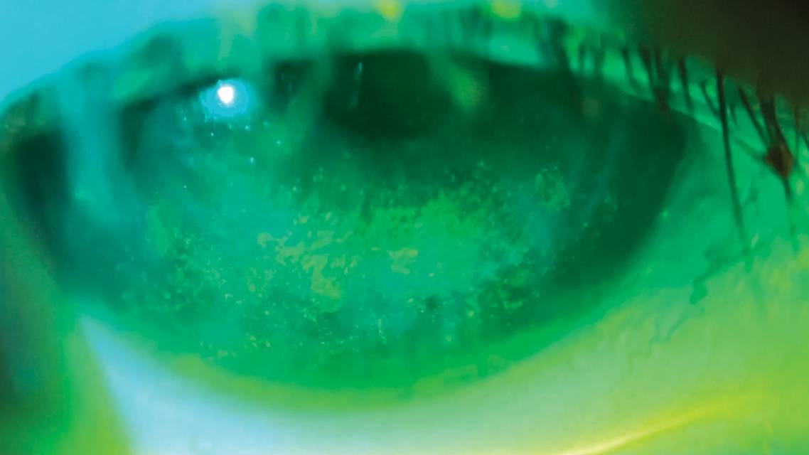 All About That Blink