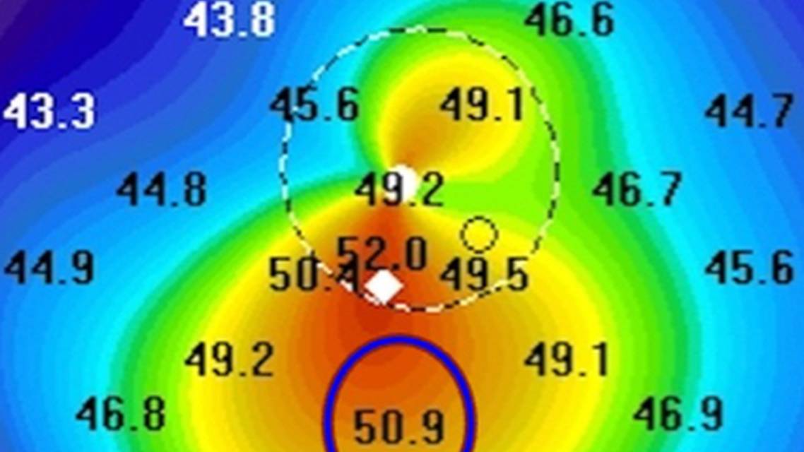 Collaborative Case 009 Two Cases of Keratoconus