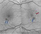 GA Case Compendium Rapid Loss of Vision Associated With Geographic Atrophy
