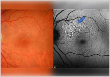 Clinical Case Compendium A Journey Through Detection Treatment Initiation and 2 Years of Active Complement Inhibition