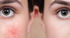 IPL Therapy and Ocular Rosacea