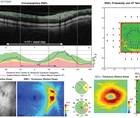 OCT imaging of glaucoma