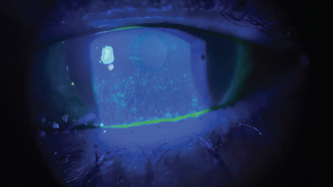 Prepping the Ocular Surface Before Cataract Surgery Referral