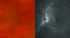 Fundus photography showed superior optic nerve edema OS with a normal and red free filter