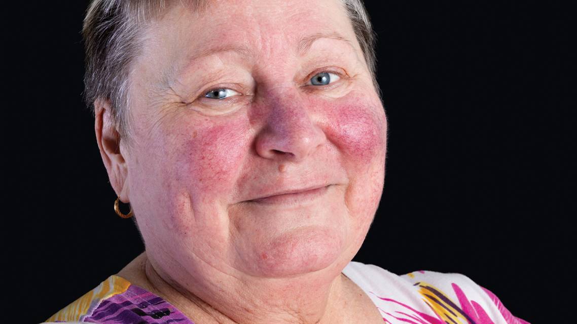 Rosacea the Eye and the Gut