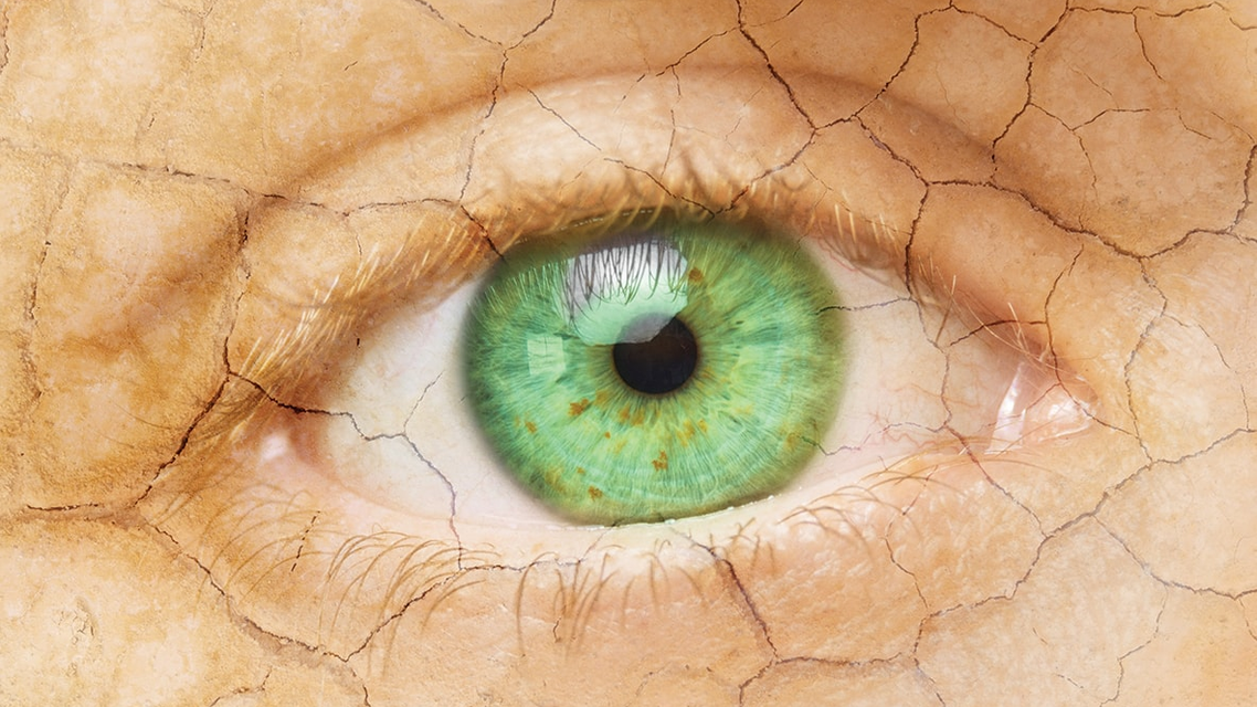 Use of Scleral Lenses For Dry Eye Disease