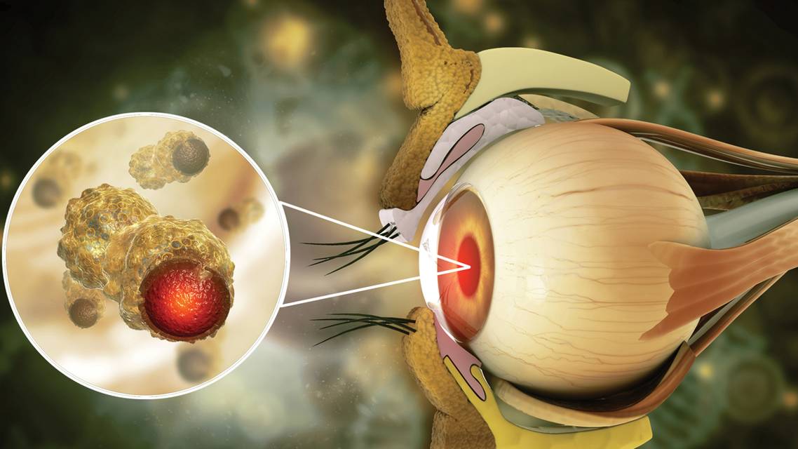 Understanding Ocular Metastatic Tumors and Simulating Lesions