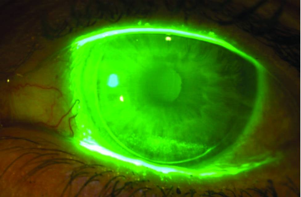 dry eye image