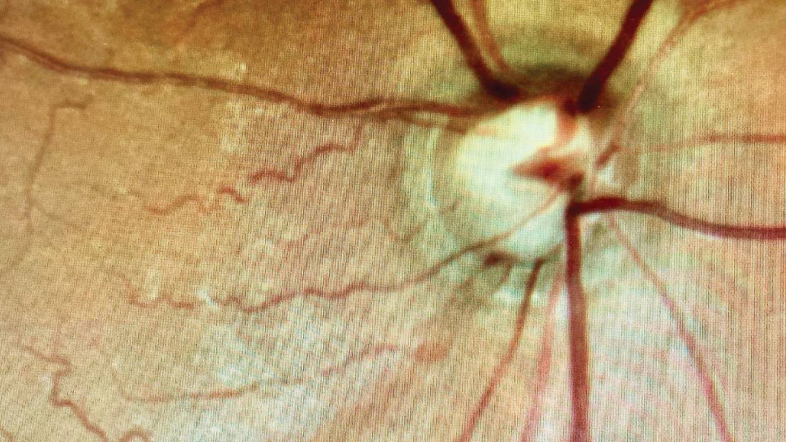 Optic Nerve Hemorrhages and Glaucoma