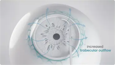 Iantrek Announces First Commercial Cases of C.Rex Micro-Interventional System for Trabecular Outflow Enhancement image
