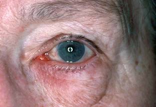 Researchers Define Keys to Recognizing Ocular Rosacea image