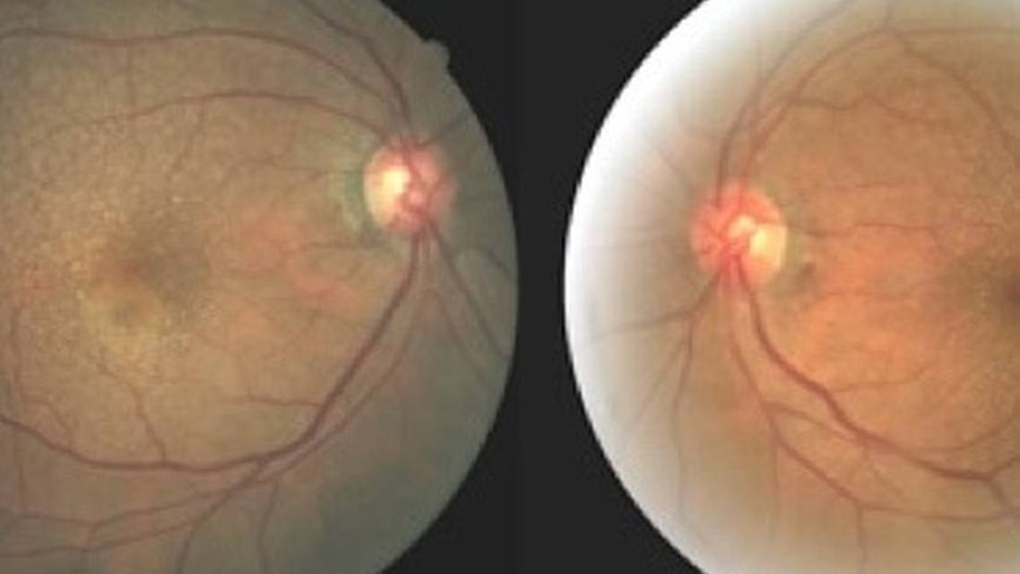 GA Case Compendium Multimodal Imaging for Following Geographic Atrophy Over Time