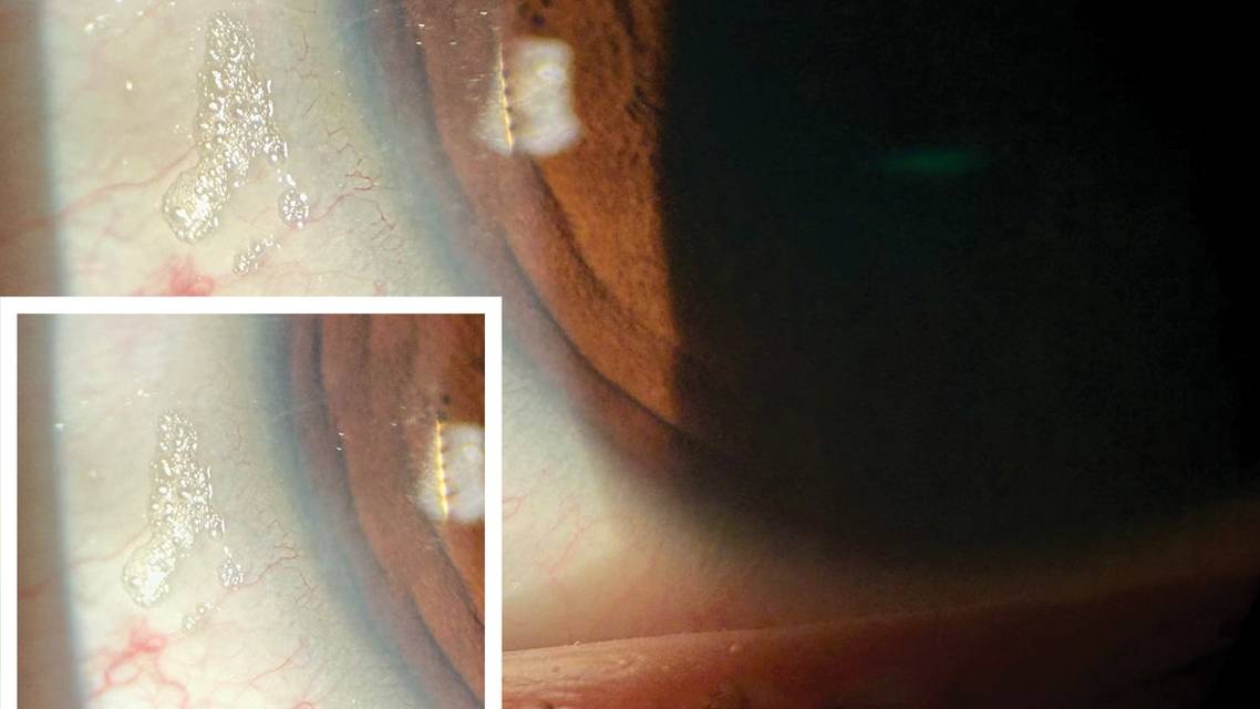Bitot Spots