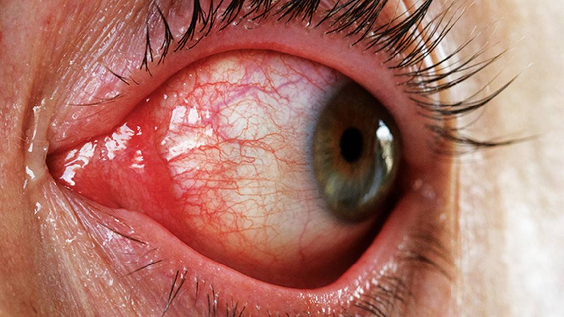 How to Handle Pink Eye