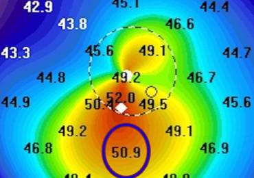 Collaborative Case 009 Two Cases of Keratoconus