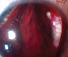 Hyphema