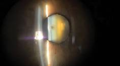Cataract Surgery