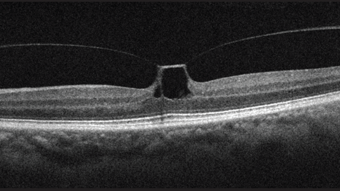 Putting the V in Vitreomacular Traction