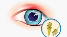 A Primer on Demodex Blepharitis