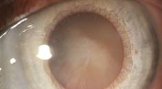 cataract