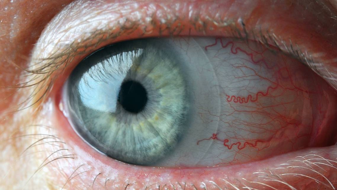 Dry Eye and the Contact Lens Wearer