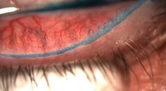 Putting a Lid on Epitheliopathy