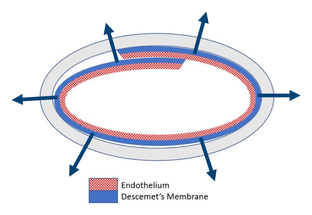 EverSight Launches Preloaded DMEK EndoGlide image