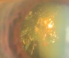 Christmas Tree Cataract