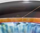 glaucoma laser surgery