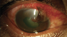 Optometrys Role in Open Globe Management