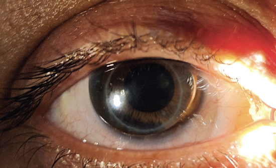 Piggyback Rgp Specialty Lenses for Vision Rehabilitation