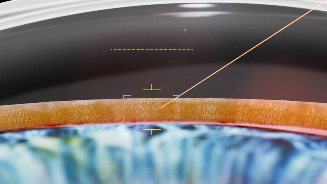 glaucoma laser surgery