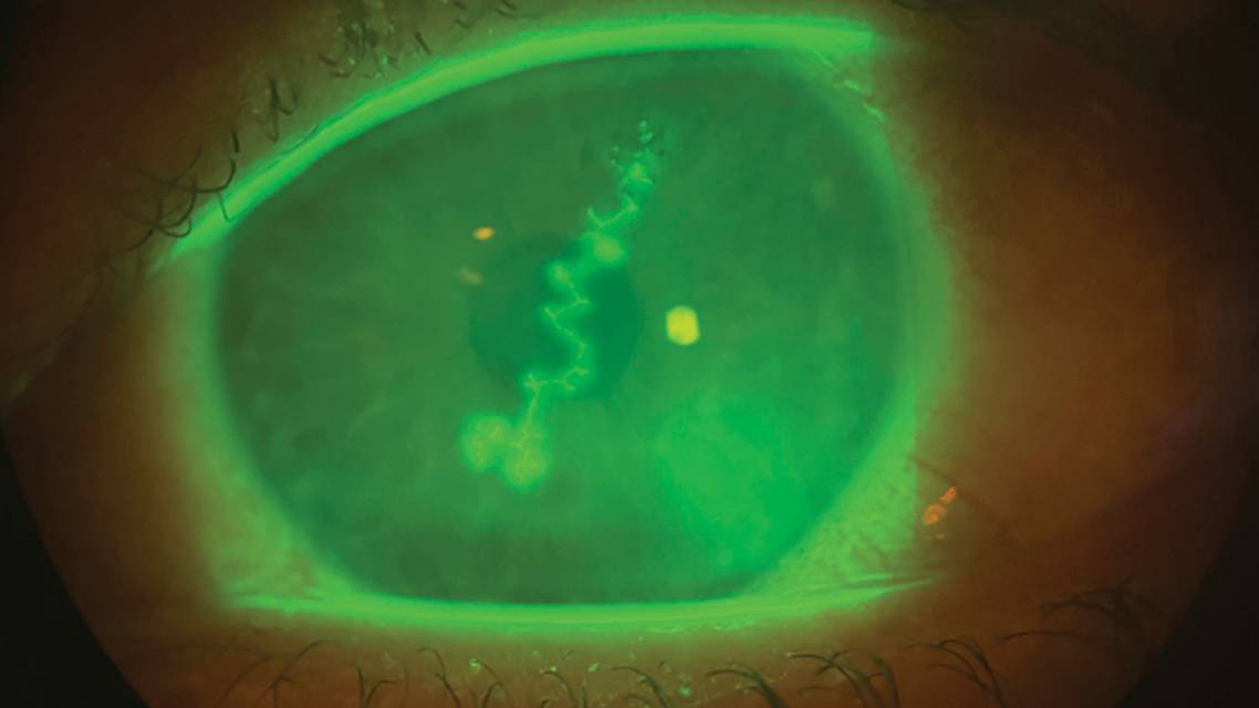 Herpes Knows No Borders