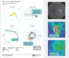 Structure and Function in Early Glaucoma Diagnosis