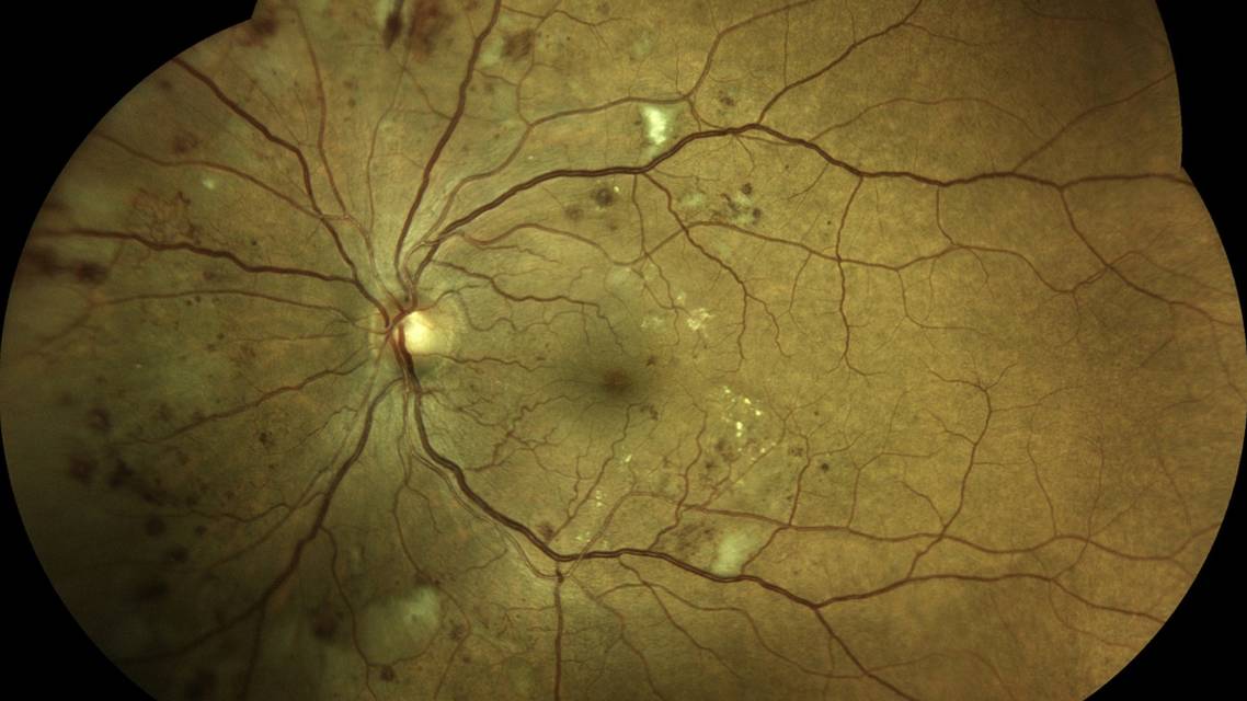 Standard Tools and Tests for Diagnosing Diabetic Retinopathy