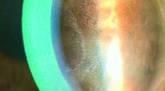 microcytic keratopathy in a patient who underwent Elahere therapy