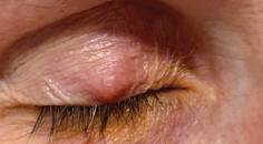 Dont Lump All Lid Lesions Together