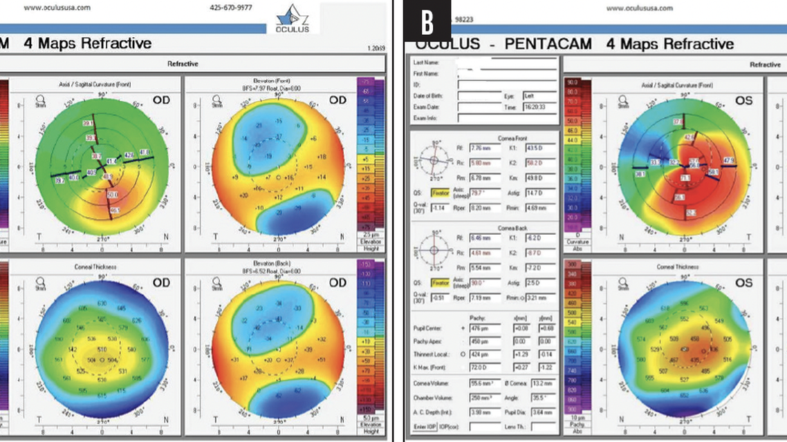 Legal Liability Issues in Keratoconus